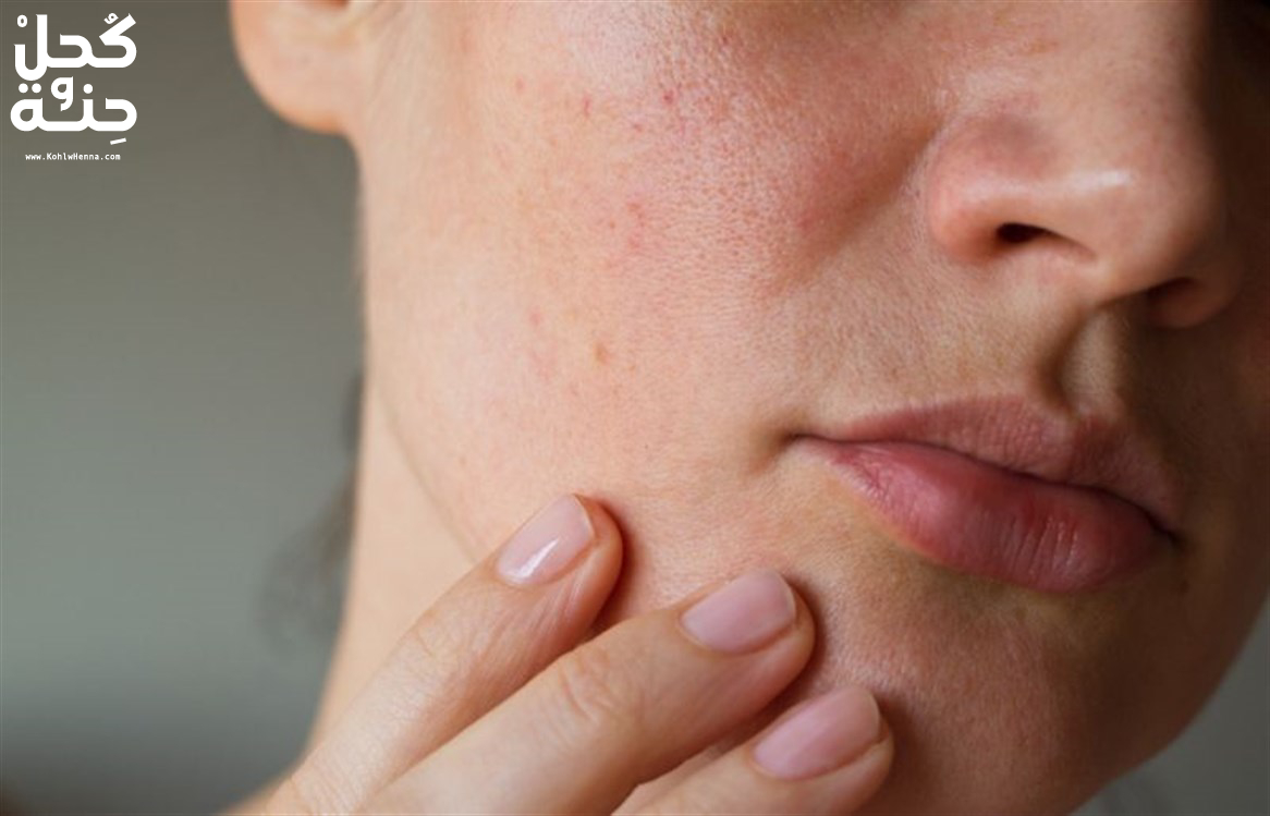 علاج حبوب تحت الجلد في الوجه